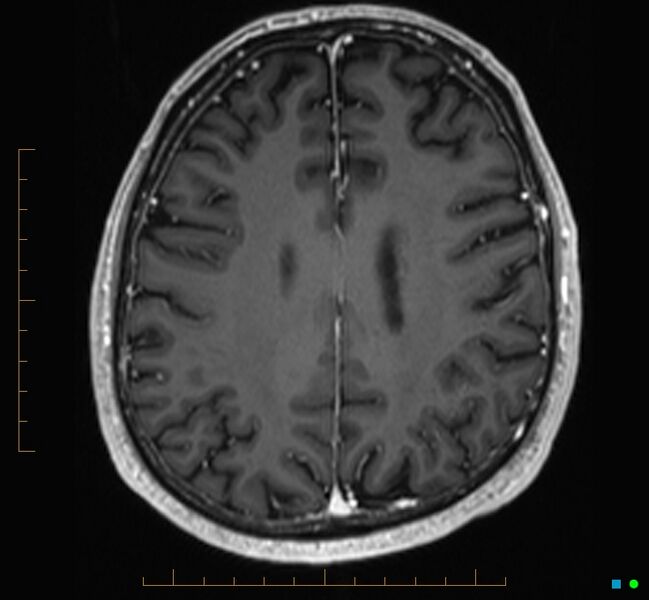 File:Cerebellar gangliocytoma (Radiopaedia 65377-74422 Axial T1 C+ 94).jpg