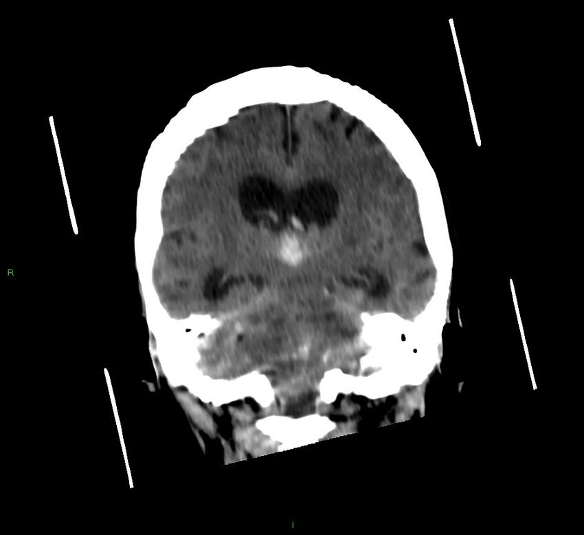 Cerebellar hemorrhage (Radiopaedia 58792-66026 Coronal non-contrast 30).jpg