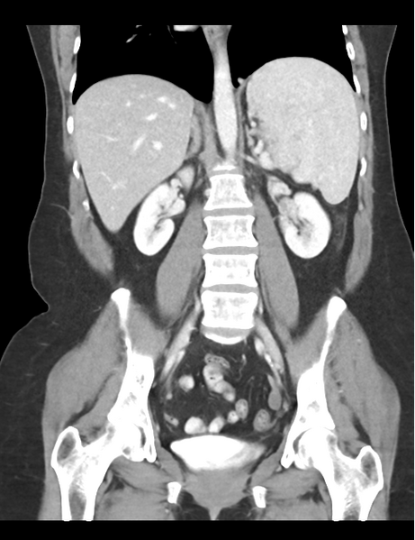 File:Cerebral abscess from pulmonary arteriovenous malformation (Radiopaedia 86275-102292 D 32).png