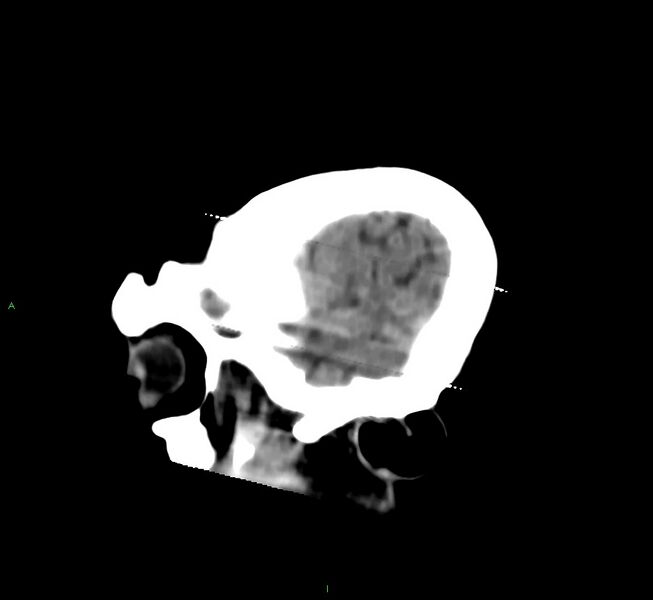 File:Cerebral amyloid angiopathy-associated lobar intracerebral hemorrhage (Radiopaedia 58377-65514 B 45).jpg