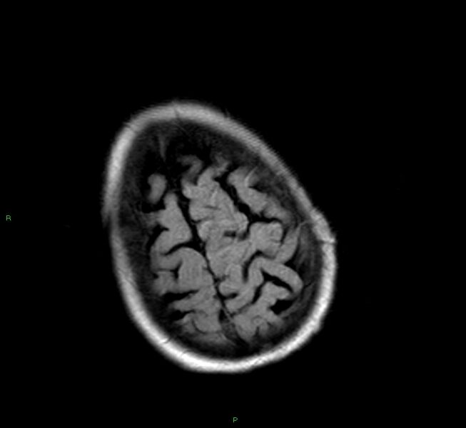 File:Cerebral amyloid angiopathy-associated lobar intracerebral hemorrhage (Radiopaedia 58377-65515 Axial FLAIR 5).jpg