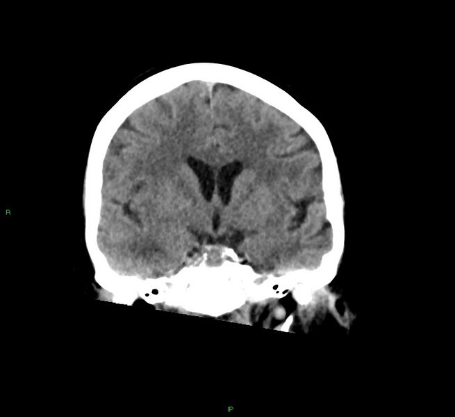File:Cerebral amyloid angiopathy-associated lobar intracerebral hemorrhage (Radiopaedia 58378-65516 Coronal non-contrast 36).jpg