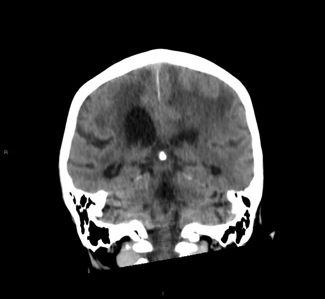 File:Cerebral amyloid angiopathy-associated lobar intracerebral hemorrhage (Radiopaedia 58530-65688 Coronal non-contrast 28).jpg