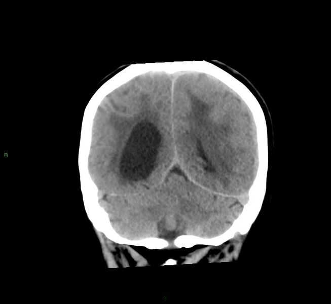 File:Cerebral amyloid angiopathy-associated lobar intracerebral hemorrhage (Radiopaedia 58561-65724 Coronal non-contrast 20).jpg