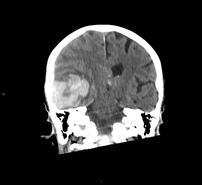 File:Cerebral amyloid angiopathy-associated lobar intracerebral hemorrhage (Radiopaedia 58758-65980 Coronal non-contrast 31).jpg