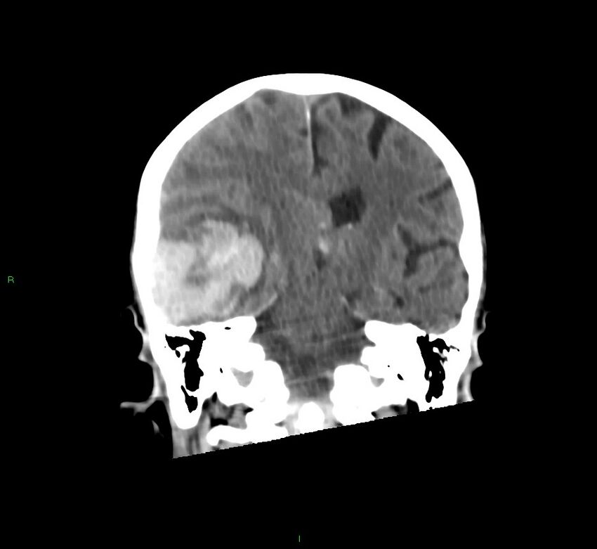 Cerebral amyloid angiopathy-associated lobar intracerebral hemorrhage (Radiopaedia 58758-65980 Coronal non-contrast 31).jpg