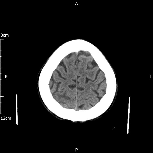 File:Cerebral amyloid angiopathy related inflammation (Radiopaedia 72772-83480 Axial non-contrast 24).jpg
