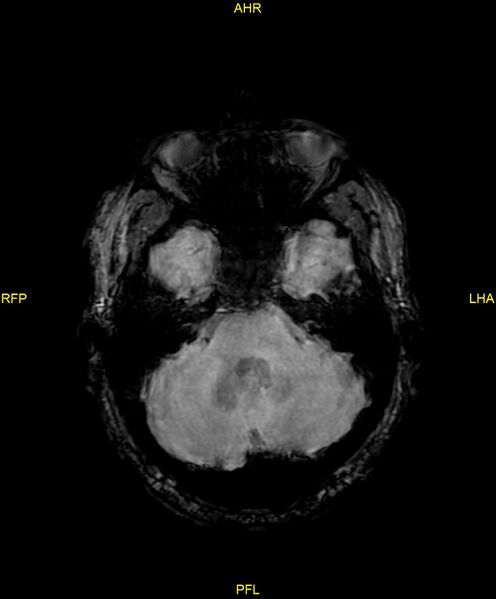 File:Cerebral autosomal dominant arteriopathy with subcortical infarcts and leukoencephalopathy (CADASIL) (Radiopaedia 86108-102054 Axial SWI 30).jpg