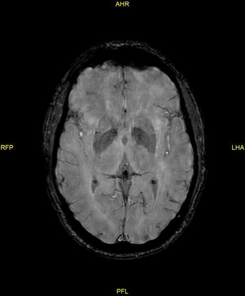 File:Cerebral autosomal dominant arteriopathy with subcortical infarcts and leukoencephalopathy (CADASIL) (Radiopaedia 86108-102054 Axial SWI 54).jpg