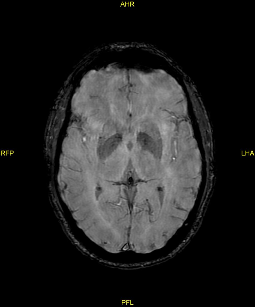 Cerebral autosomal dominant arteriopathy with subcortical infarcts and leukoencephalopathy (CADASIL) (Radiopaedia 86108-102054 Axial SWI 54).jpg