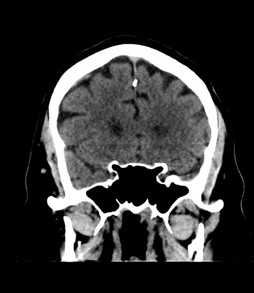 File:Cerebral dural venous sinus thrombosis (Radiopaedia 86514-102575 Coronal non-contrast 14).jpg