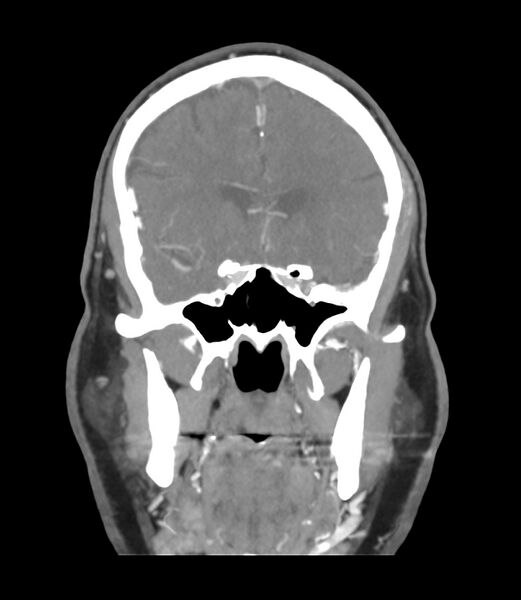 File:Cerebral dural venous sinus thrombosis (Radiopaedia 86514-102576 B 21).jpg