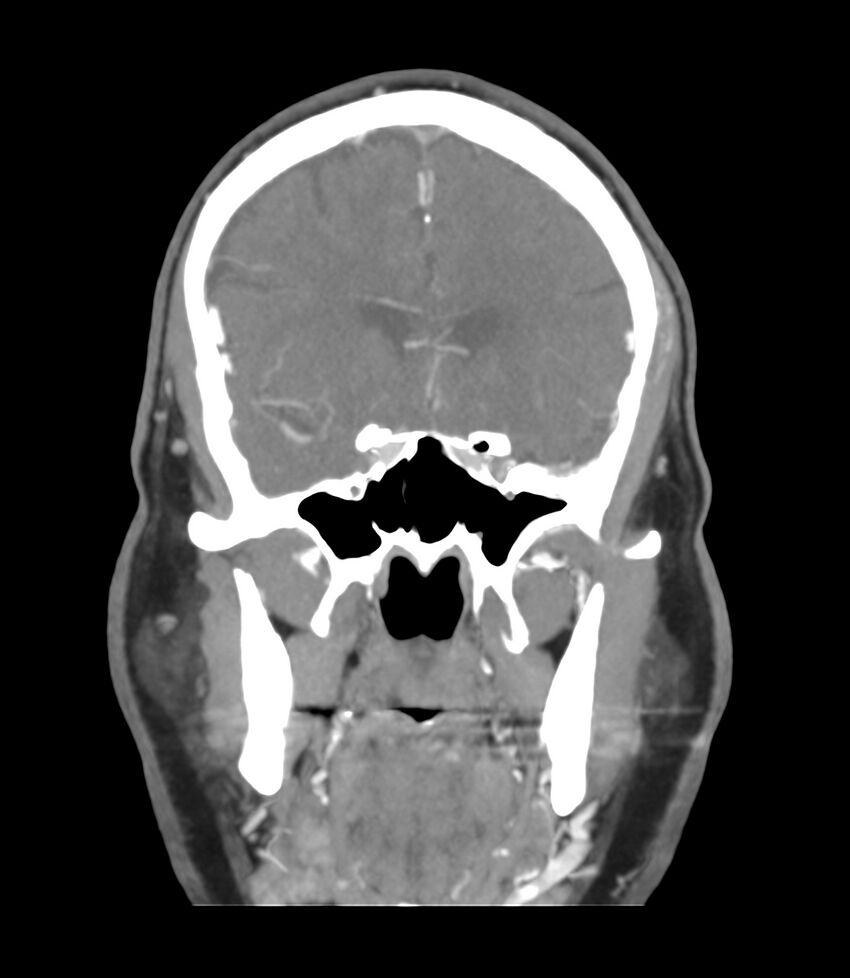 Cerebral dural venous sinus thrombosis (Radiopaedia 86514-102576 B 21).jpg