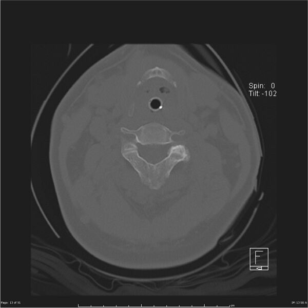 File:Cerebral hemorrhagic contusions and cervical spine fractures (Radiopaedia 32865-33841 C 13).jpg