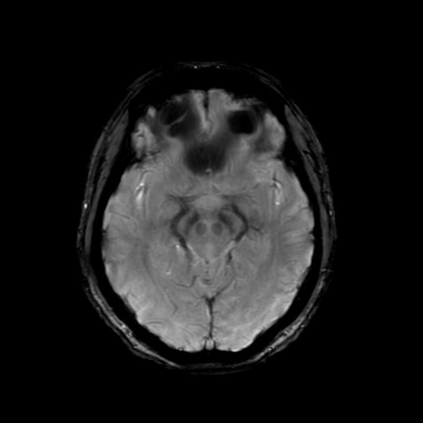 Cerebral paragonimiasis (Radiopaedia 73473-84238 Axial SWI 30).jpg
