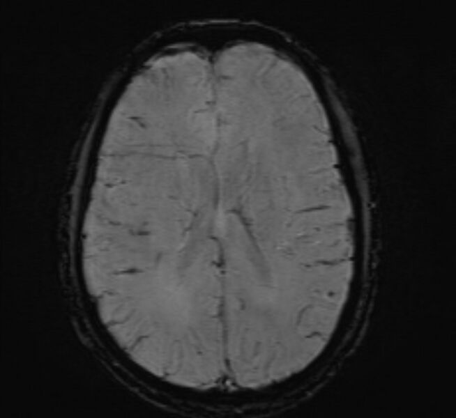 File:Cerebral venous thrombosis (Radiopaedia 71207-81504 Axial SWI 33).jpg