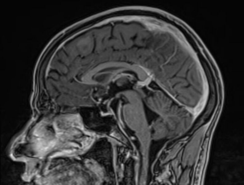 File:Cerebral venous thrombosis (Radiopaedia 71207-81504 Sagittal T1 C+ 31).jpg