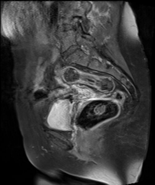 File:Cervical carcinoma (Radiopaedia 88312-104943 E 13).jpg