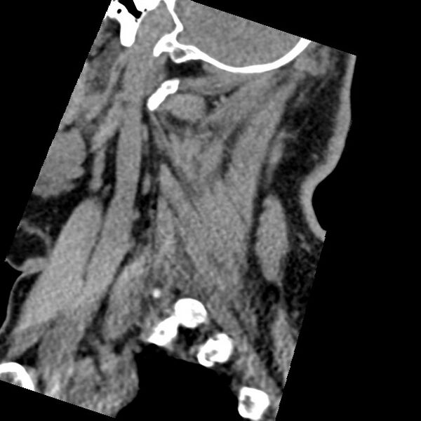 File:Cervical spinal neurofibroma in a patient with NF1 (Radiopaedia 58344-65464 C 45).jpg