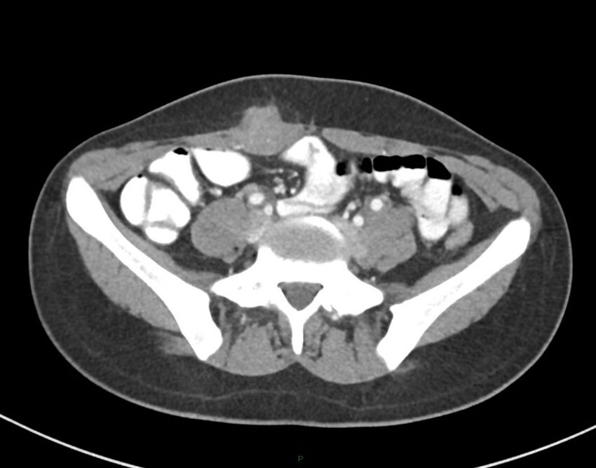 Cesarean scar endometriosis (Radiopaedia 82925-97262 A 58).jpg