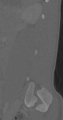Chance fracture (Radiopaedia 40360-42912 Sagittal bone window 24).png