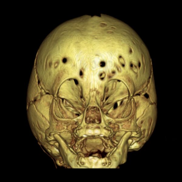 File:Chiari I and severe copper beaten skull (Radiopaedia 5993-7504 B 1).jpg