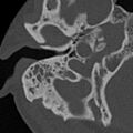 Cholesteatoma (Radiopaedia 15846-15494 bone window 23).jpg
