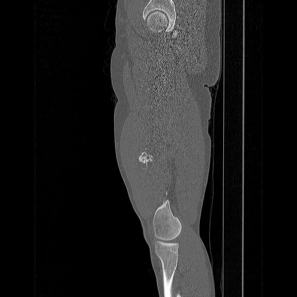 File:Chondrosarcoma arising from exostosis (Radiopaedia 59996-67507 Sagittal bone window 16).jpg