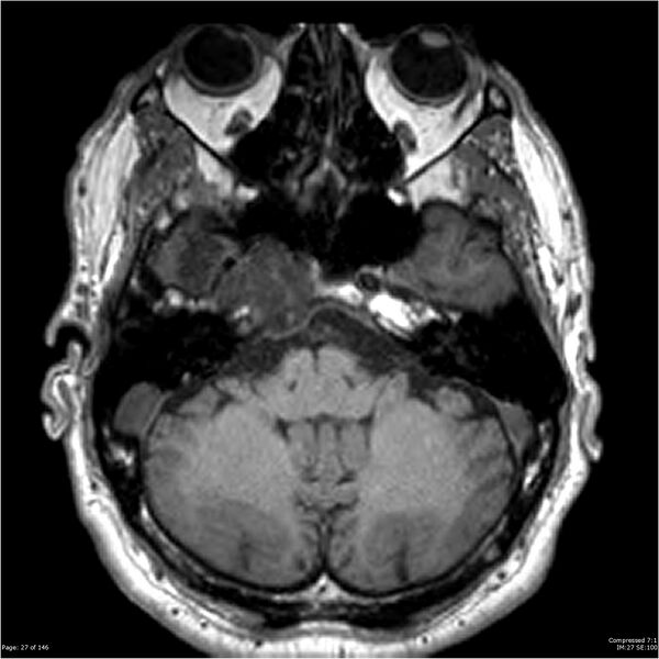 File:Chondrosarcoma of skull base- grade II (Radiopaedia 40948-43654 Axial T1 27).jpg