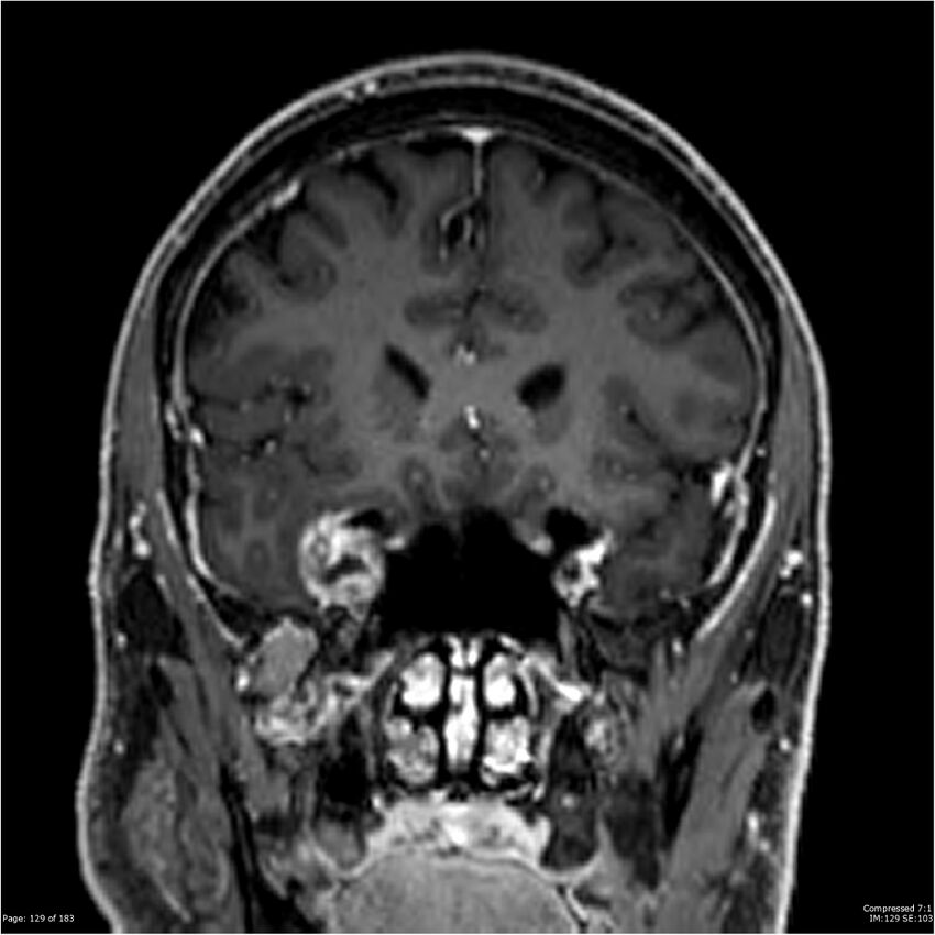 Chondrosarcoma of skull base- grade II (Radiopaedia 40948-43654 Coronal T1 C+ 40).jpg