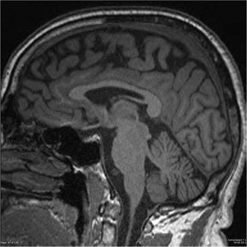 Chondrosarcoma of skull base- grade II (Radiopaedia 40948-43654 Sagittal T1 8).jpg