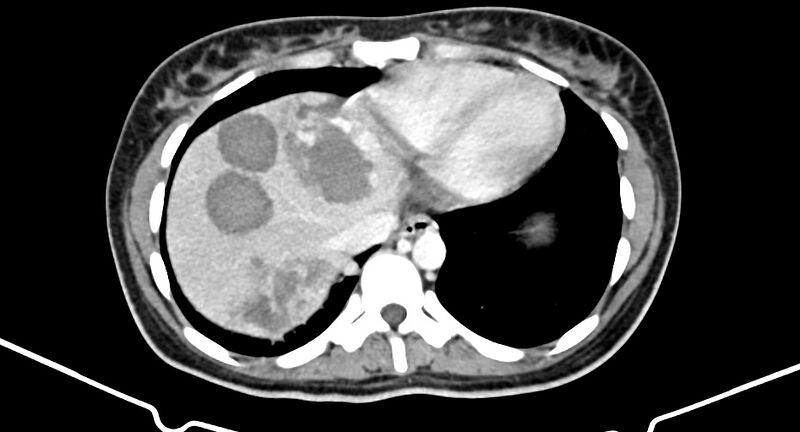 File:Choriocarcinoma liver metastases (Radiopaedia 74768-85766 A 25).jpg