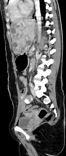 File:Choriocarcinoma liver metastases (Radiopaedia 74768-85766 C 88).jpg