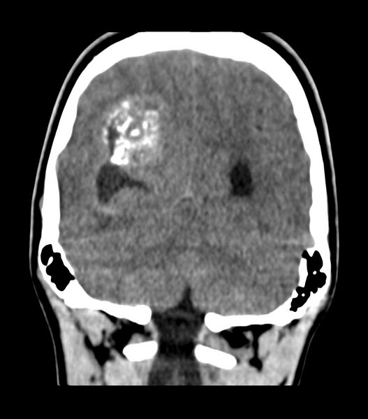 File:Choroid plexus carcinoma (Radiopaedia 91013-108552 Coronal non-contrast 66).jpg