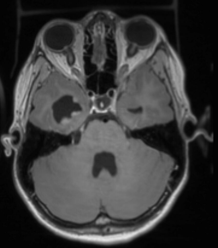 Choroid plexus carcinoma (Radiopaedia 91013-108553 Axial T1 C+ 103).jpg