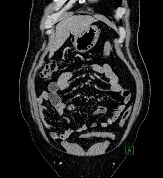 File:Chromophobe renal cell carcinoma (Radiopaedia 84286-99573 H 40).jpg
