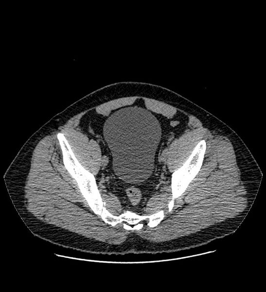 File:Chromophobe renal cell carcinoma (Radiopaedia 84337-99693 Axial non-contrast 134).jpg