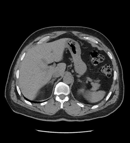 File:Chromophobe renal cell carcinoma (Radiopaedia 86879-103083 Axial non-contrast 14).jpg