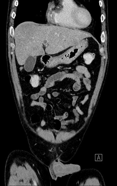 File:Chronic appendicitis complicated by appendicular abscess, pylephlebitis and liver abscess (Radiopaedia 54483-60700 C 21).jpg
