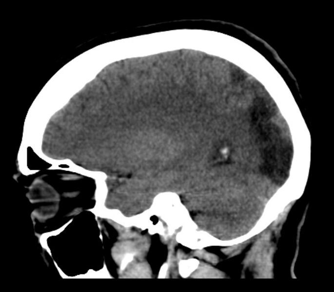 File:Chronic bilateral occipital lobe infarcts (Radiopaedia 31276-31996 C 14).jpg