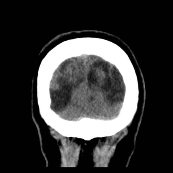 File:Chronic bilateral occipital lobe infarcts (Radiopaedia 31276-31996 Coronal non-contrast 43).jpg