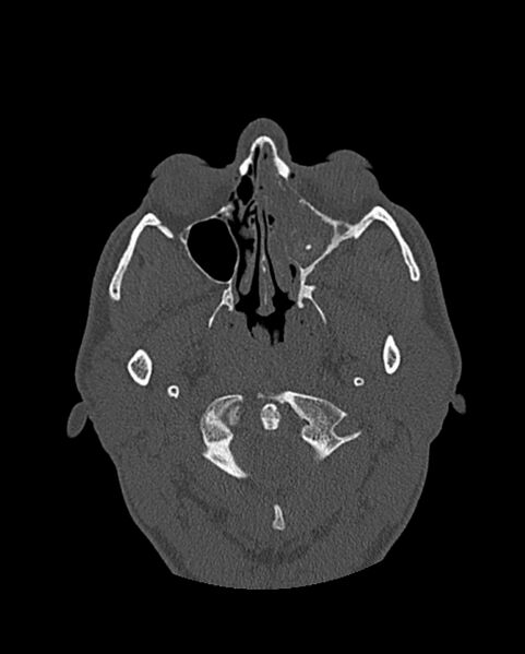 File:Chronic maxillary sinusitis caused by a foreign body (Radiopaedia 58521-65676 Axial bone window 153).jpg