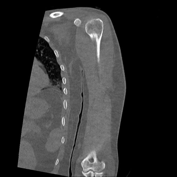 File:Chronic osteomyelitis (Radiopaedia 67597-76998 Coronal bone window 4).jpg