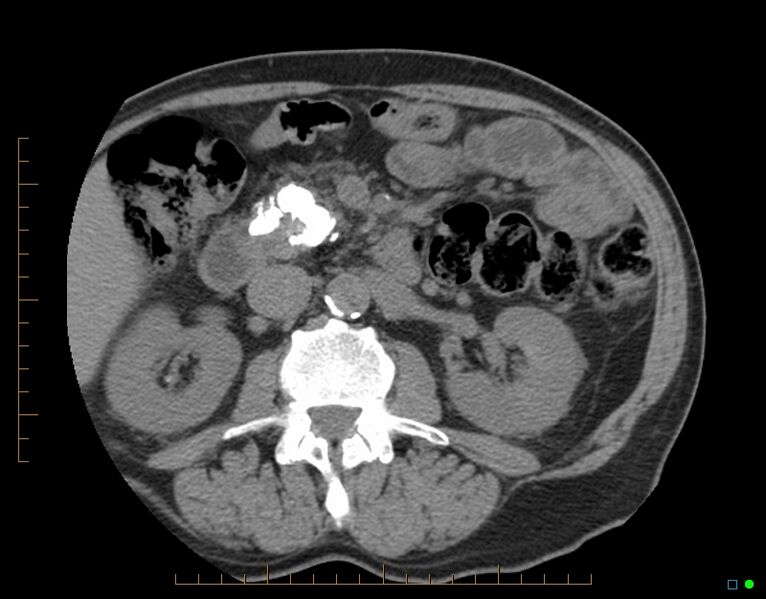 File:Chronic pancreatitis (Radiopaedia 17014-16717 Axial non-contrast 1).jpg
