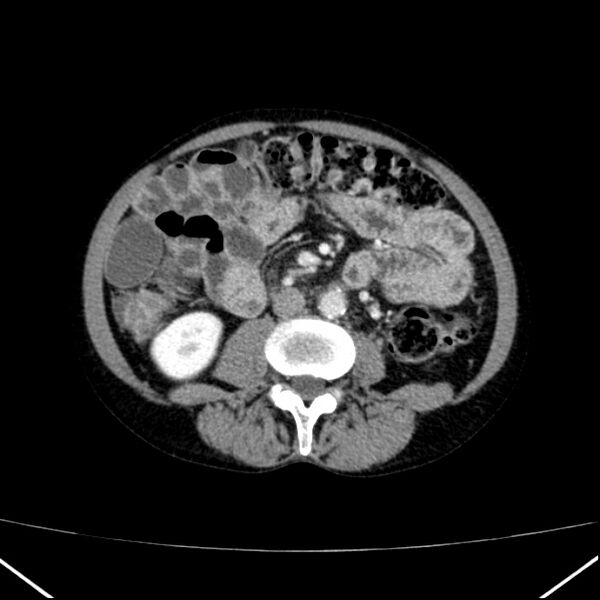 File:Chronic pancreatitis (Radiopaedia 23132-23172 B 34).jpg