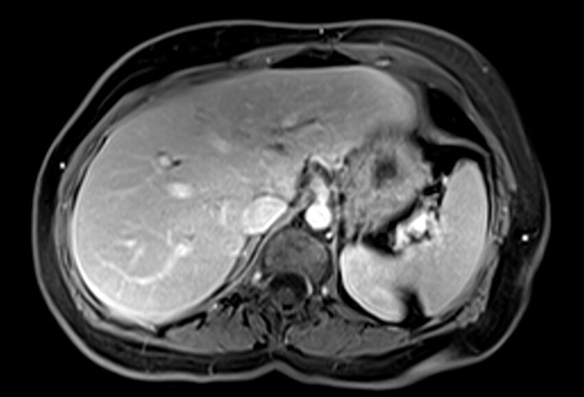 Chronic pancreatitis - pancreatic duct calculi (Radiopaedia 71818-82250 Axial T1 C+ fat sat 16).jpg