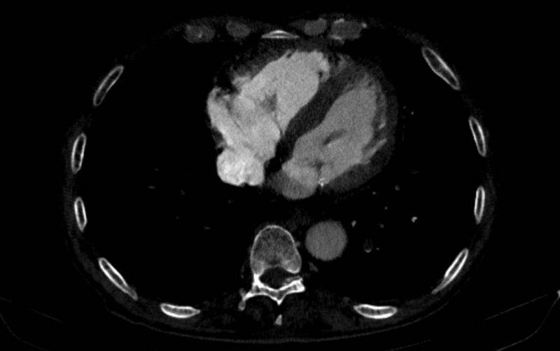 File:Chronic pulmonary embolism (Radiopaedia 91241-108843 B 135).jpg