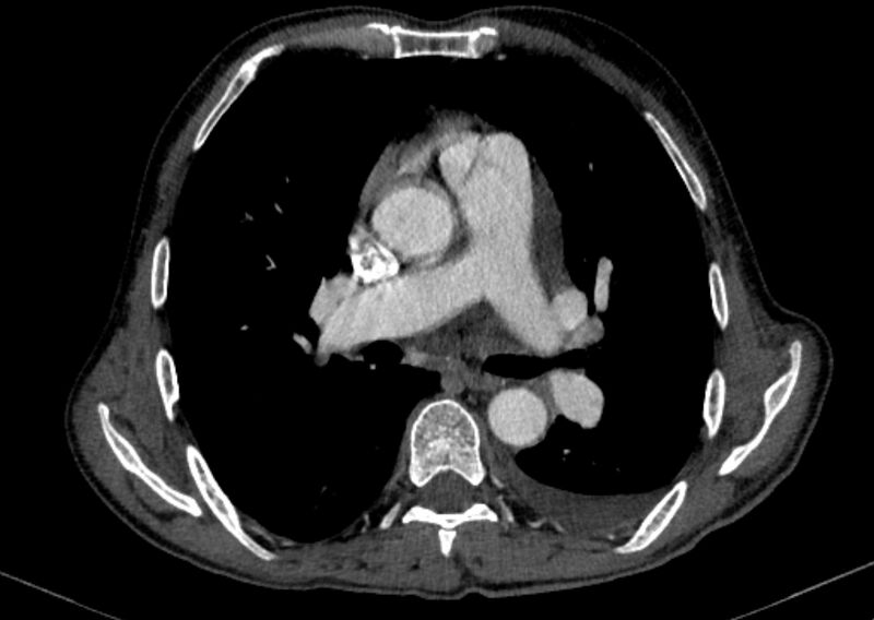File:Chronic pulmonary embolism with bubbly consolidation (Radiopaedia 91248-108850 C+ arterial phase 73).jpg
