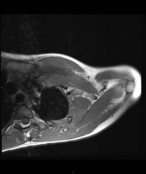 File:Chronic reactive multifocal osteomyelitis (CRMO) - clavicle (Radiopaedia 56406-63071 Axial T1 11).jpg