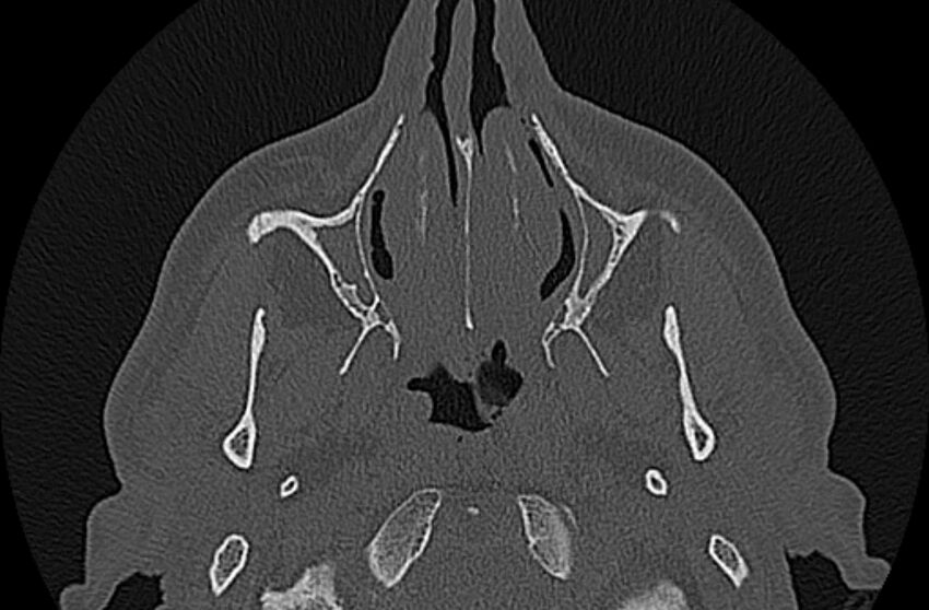Chronic rhinosinusitis (Radiopaedia 65079-74075 Axial bone window 17).jpg